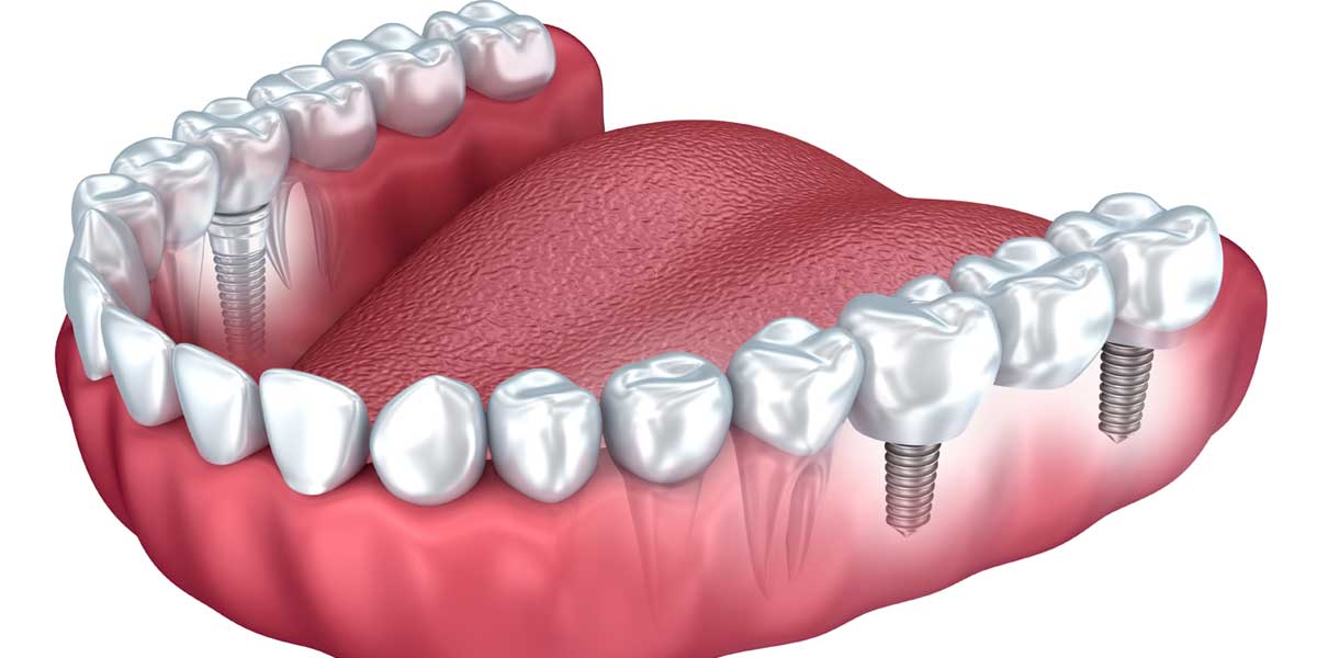 Dental Implants 3D
