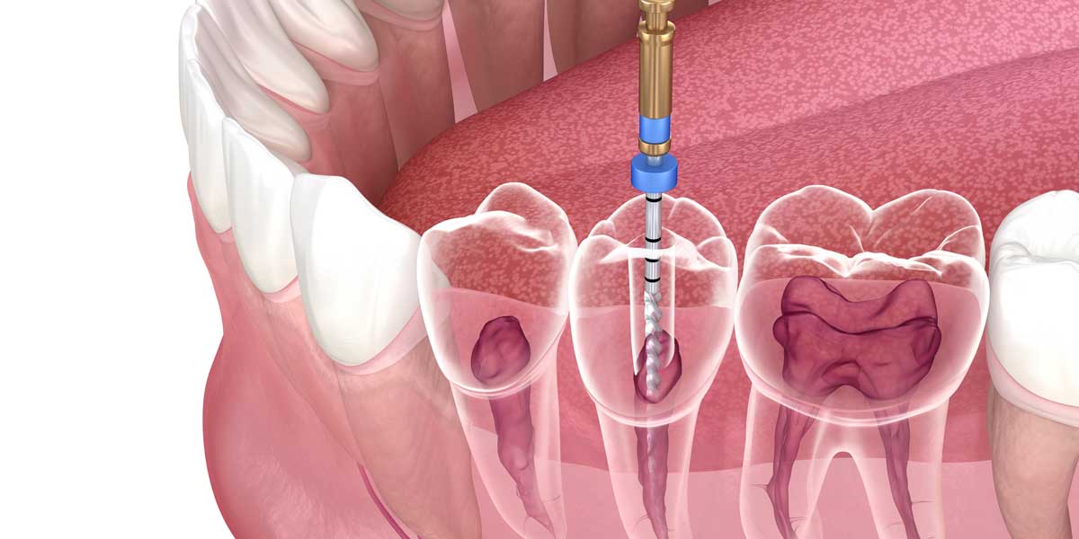 Root Canal 3D