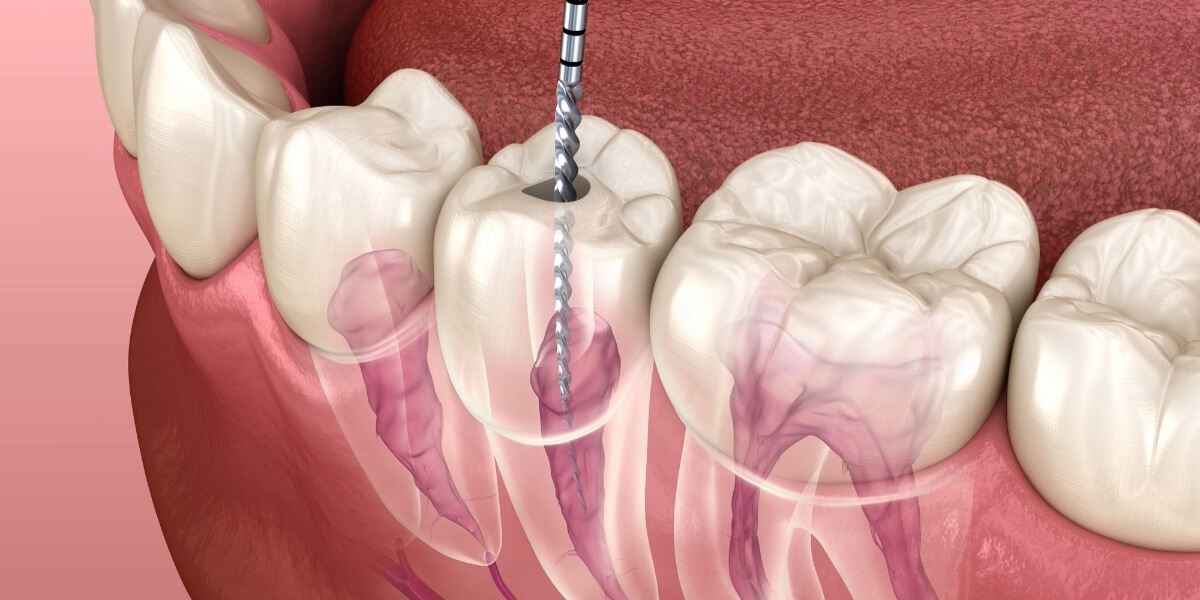 Preserve Your Teeth and Oral Health with Effective Root Canal Treatment