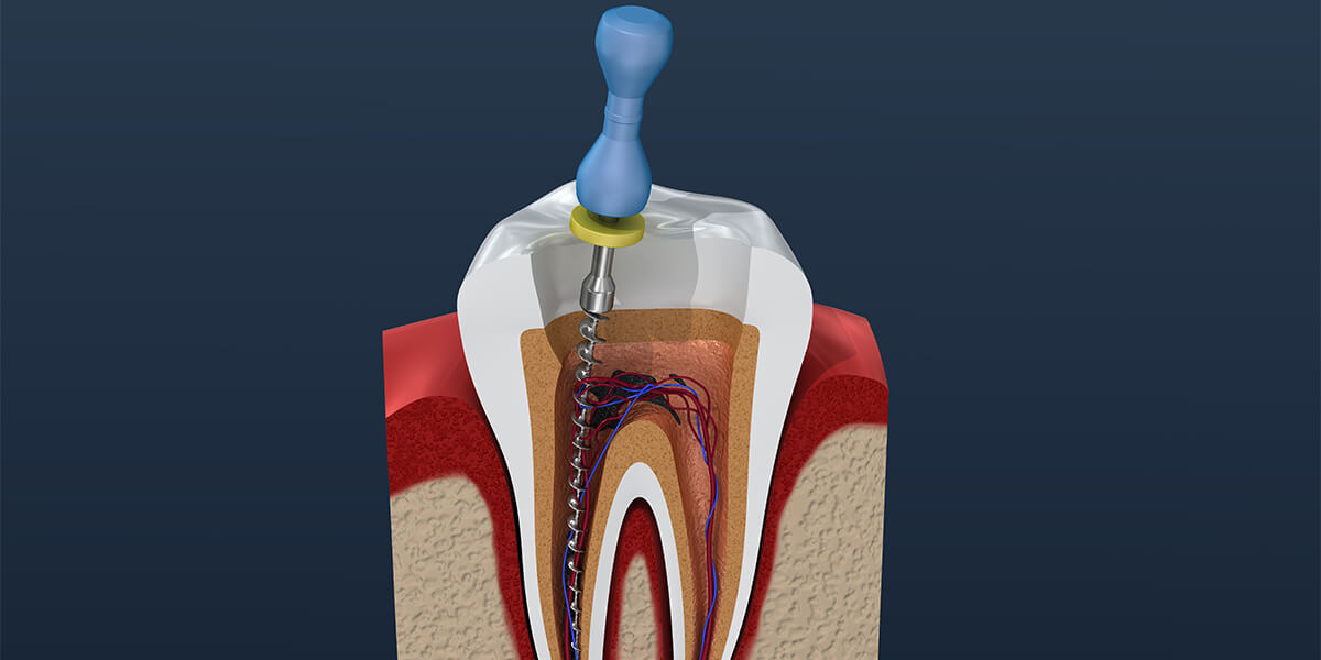 Dentist That Do Root Canals in Huntington NY Area