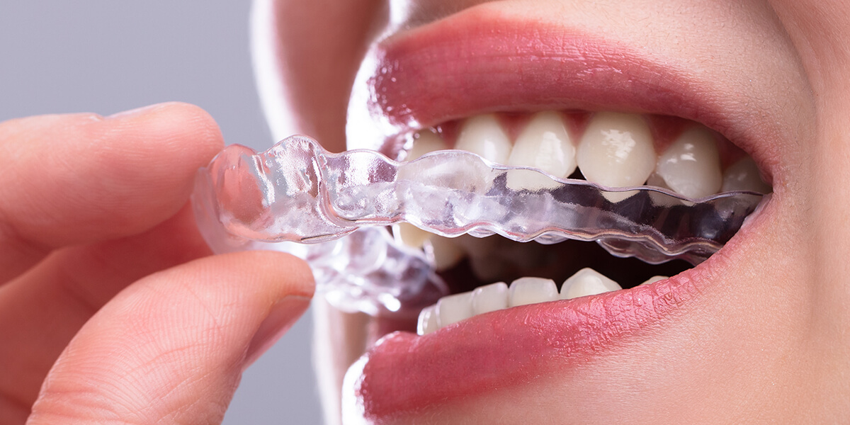Do You Sleep With Invisalign? Here is What You Need to Know