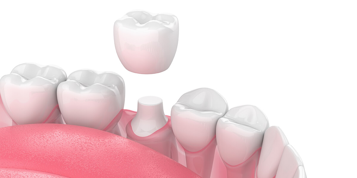 How Long Do Porcelain Crowns Last in South Huntington NY Area