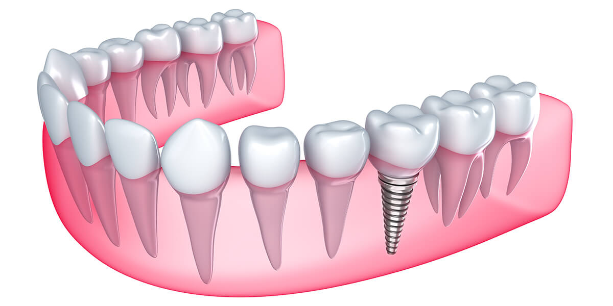 How Many Teeth Can You Have on Implants in South Huntington NY Area