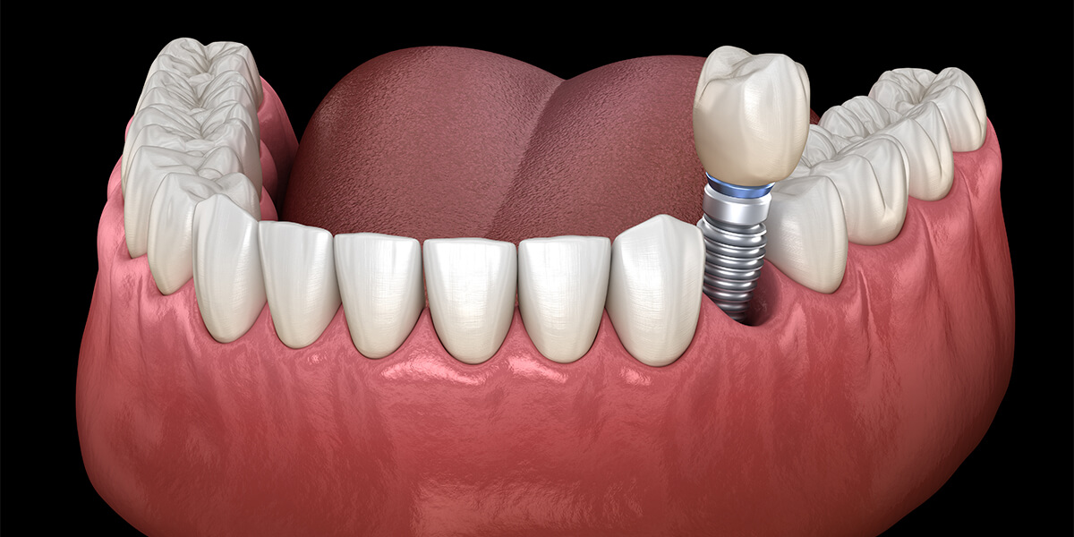 The Actual Truth Behind Some Common Dental Implant Myths You May Have Heard