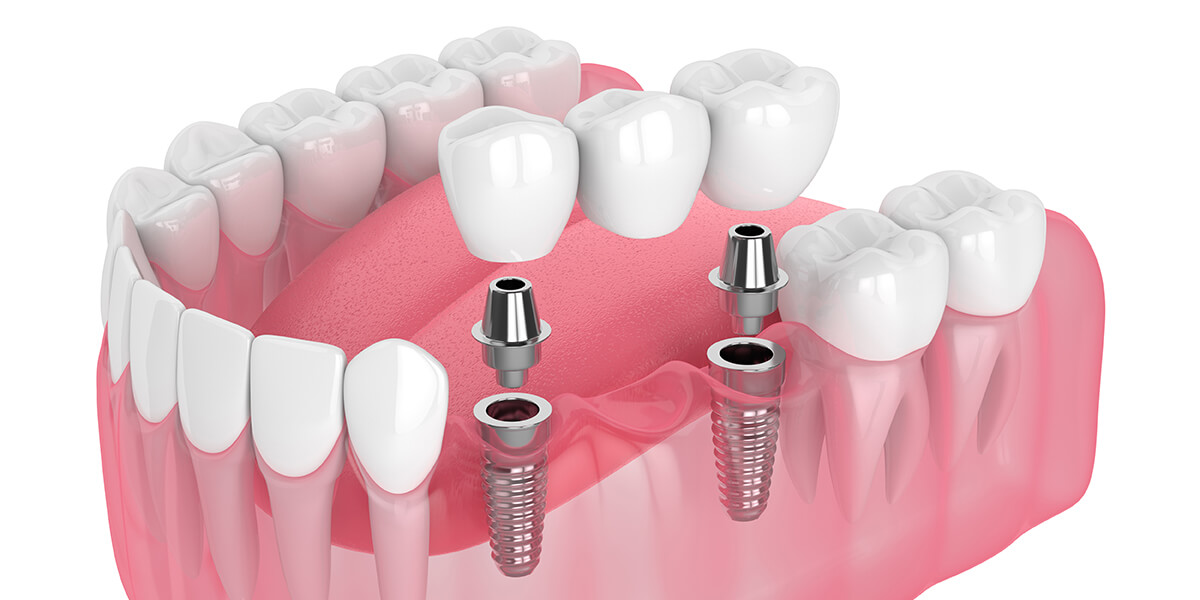 What is Denture Stabilization in South Huntington NY Area