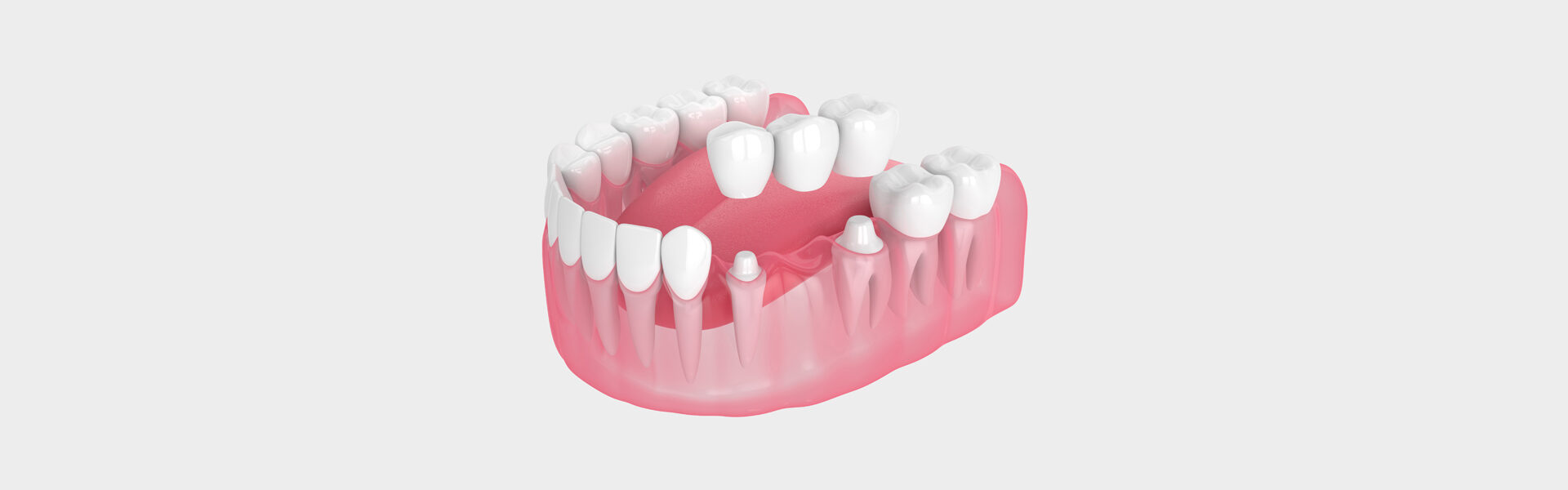 Strong & Natural-Looking Dental Bridges in Huntington Station, NY