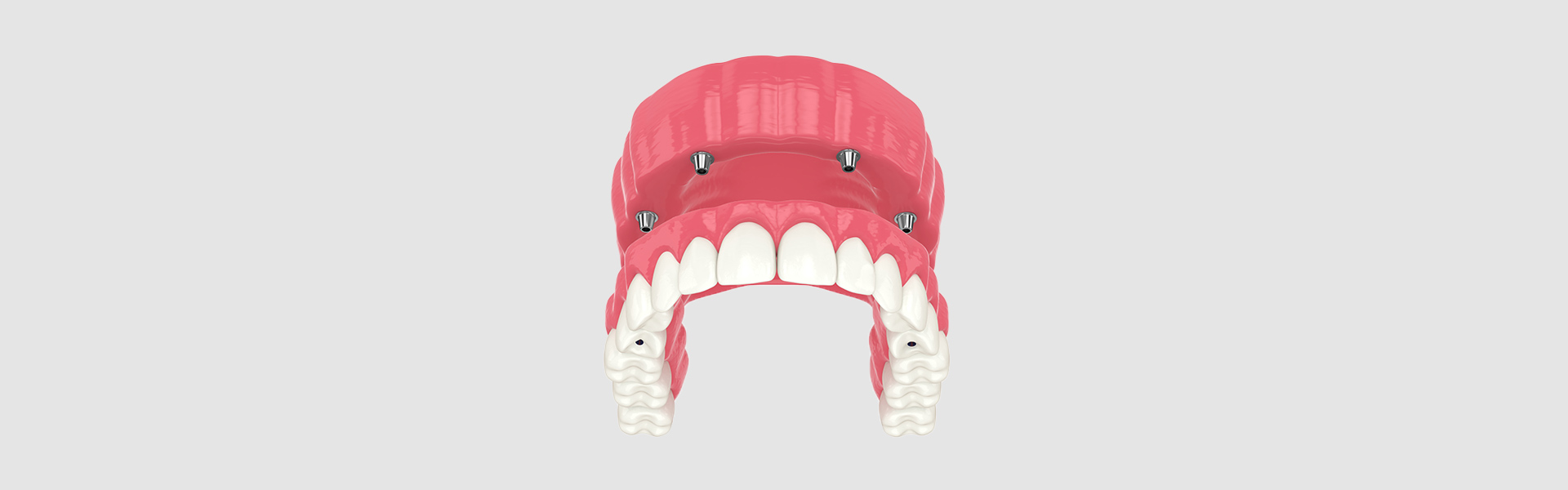 What Is the All-on-4 Implant Procedure Like?