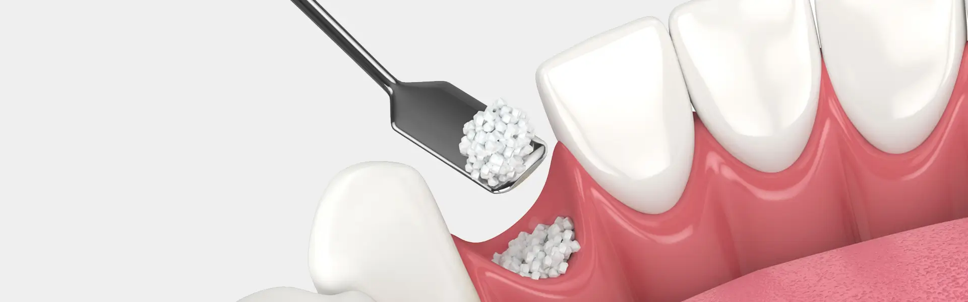 What Is Bone Grafting and Why Is It Needed?